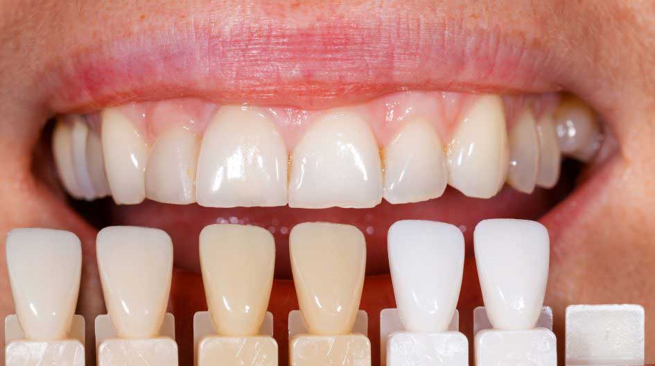 How Spectrophotometry helps in Tooth Color Analysis?