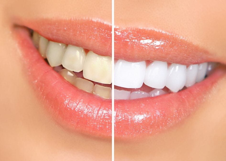 Spectral Analysis of Color in Tooth Whitening Solution